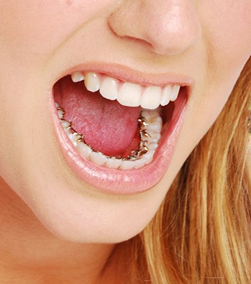 Lingual Hidden Braces in London  Behind the Teeth Braces : ODL